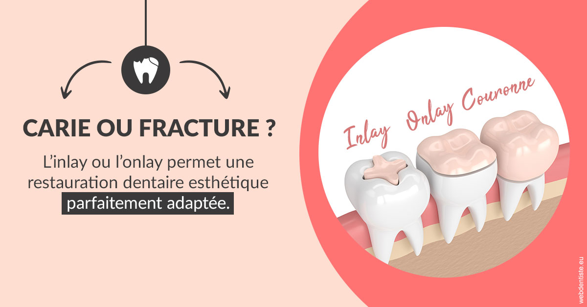 https://dr-david-temstet.chirurgiens-dentistes.fr/T2 2023 - Carie ou fracture 2