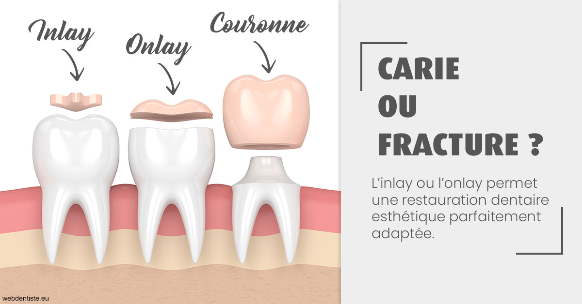 https://dr-david-temstet.chirurgiens-dentistes.fr/T2 2023 - Carie ou fracture 1