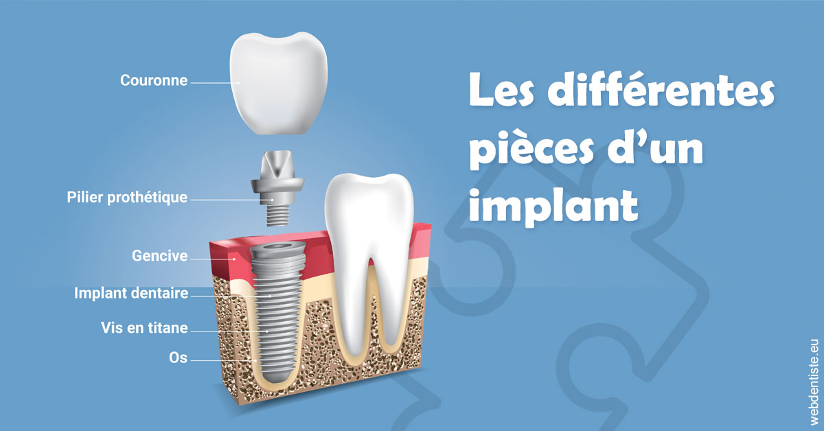 https://dr-david-temstet.chirurgiens-dentistes.fr/Les différentes pièces d’un implant 1